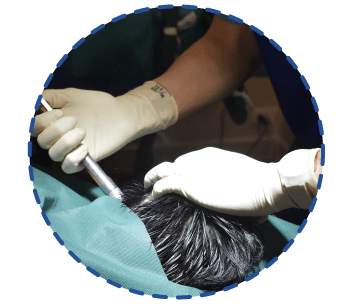Recell Hair Transplant,Hair Regrowth,FUE