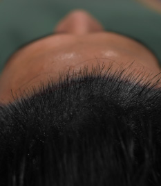 Hair Restoration,Bald Hair,Hair Loss Treatment