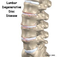 Lumber  Degenerative Disk Disease