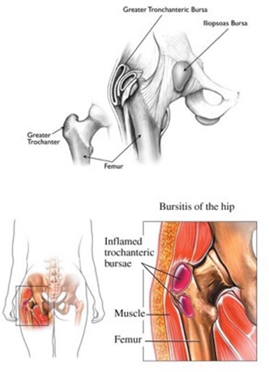 Physical Therapy for Hip Bursitis