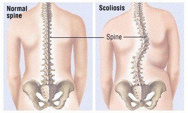 Physical Therapy for Scoliosis