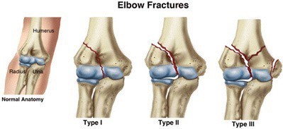 Physical Therapy for Elbow Fractures