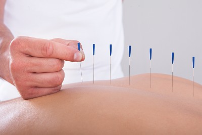 Acupuncture treatment - physical therapy