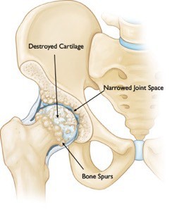 Physical Therapy for Hip Osteoarthritis
