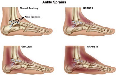 Physical Therapy for Ankle Sprains