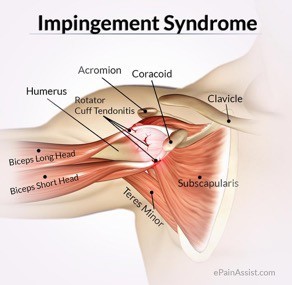 Physical Therapy for shoulder Impingement Syndrome