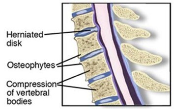 Physical Therapy for Degenerative Disk Disease