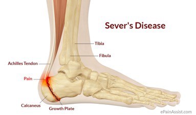 Physical Therapy for Severd Disease