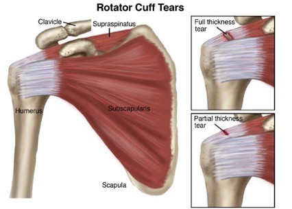 Physical Therapy for Rotator Cuff Tear