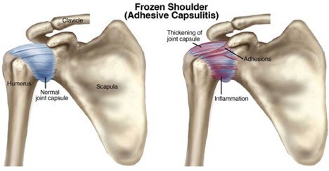 Physical Therapy for Frozen Shoulder