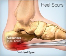 Physical Therapy for Heel Spurs
